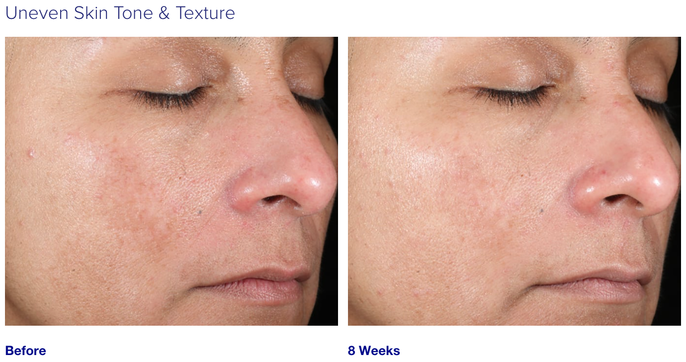 iS Clinical Active Peel System