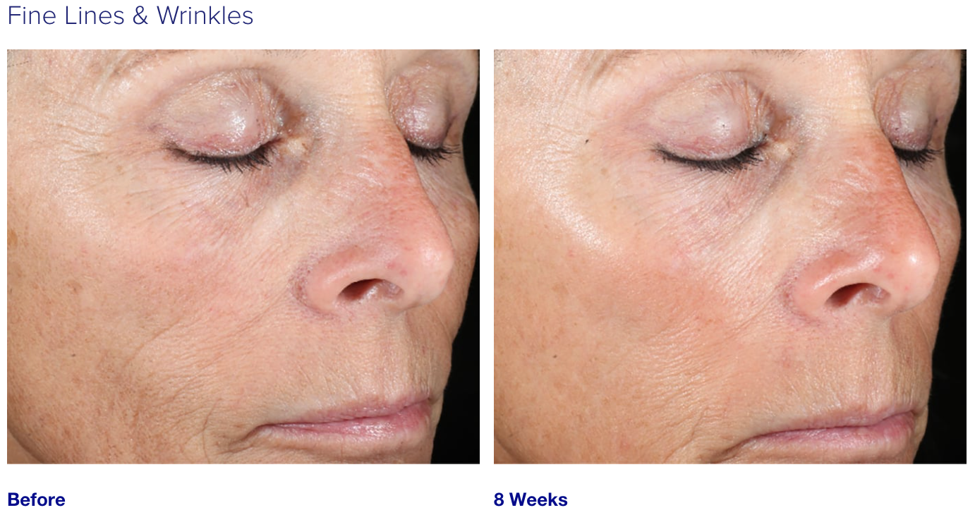 iS Clinical Active Peel System