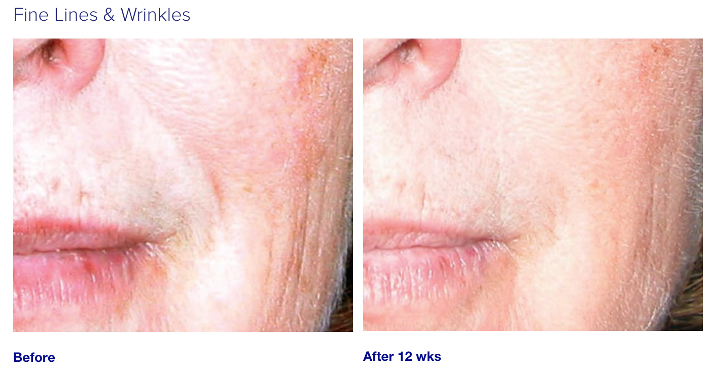 iS Clinical Active Serum