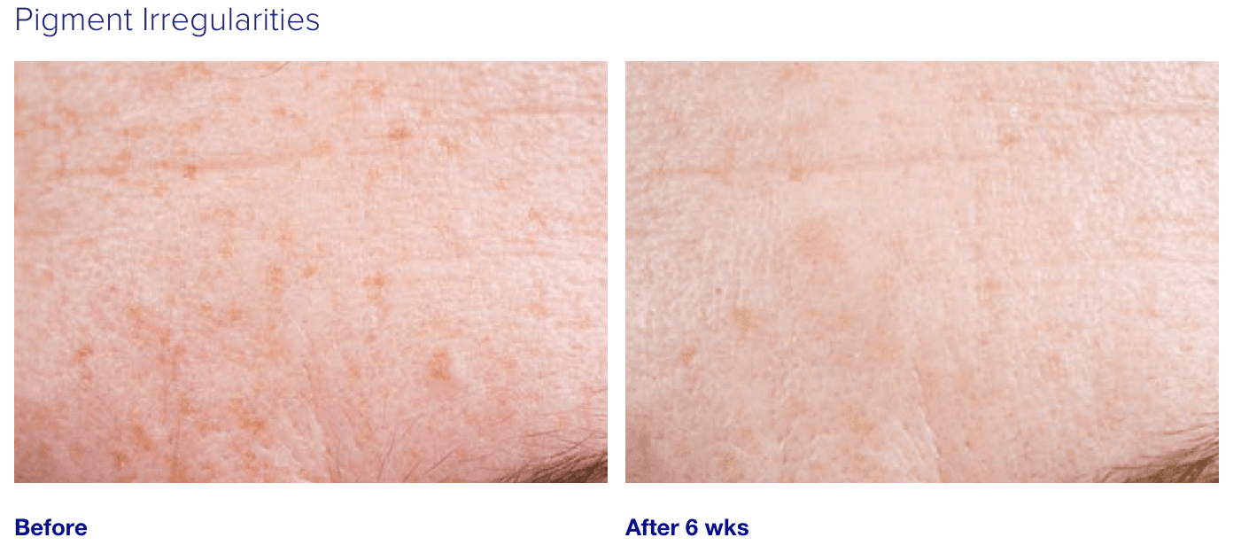 iS Clinical Active Serum
