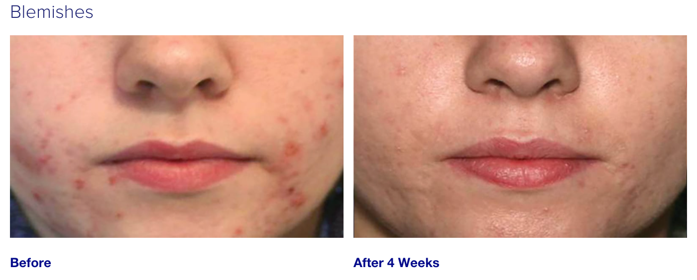 iS Clinical Active Serum